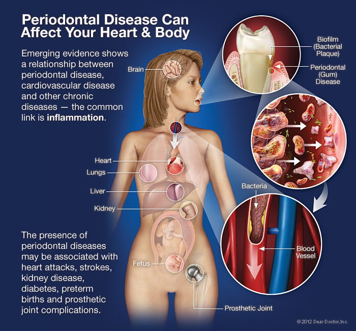Periodontal Disease Can Affect Your Body