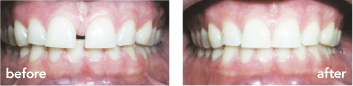 Gap/Diastema Gap/Diastema